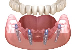 Types of Bone Grafts Used For Dental Implants